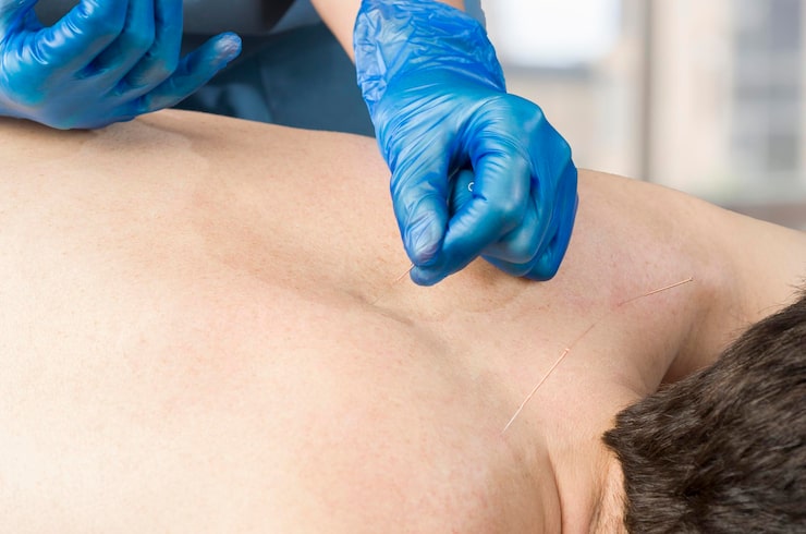 acupuncturist-inserting-acupuncture-needles-into-patients-skin_1048944-7788447